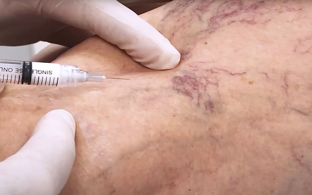 Vein Ablation and Sclerotherapy