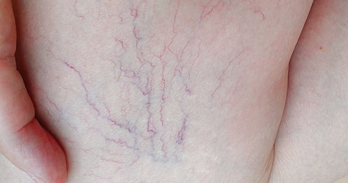 Microsclerotherapy for Spider Veins