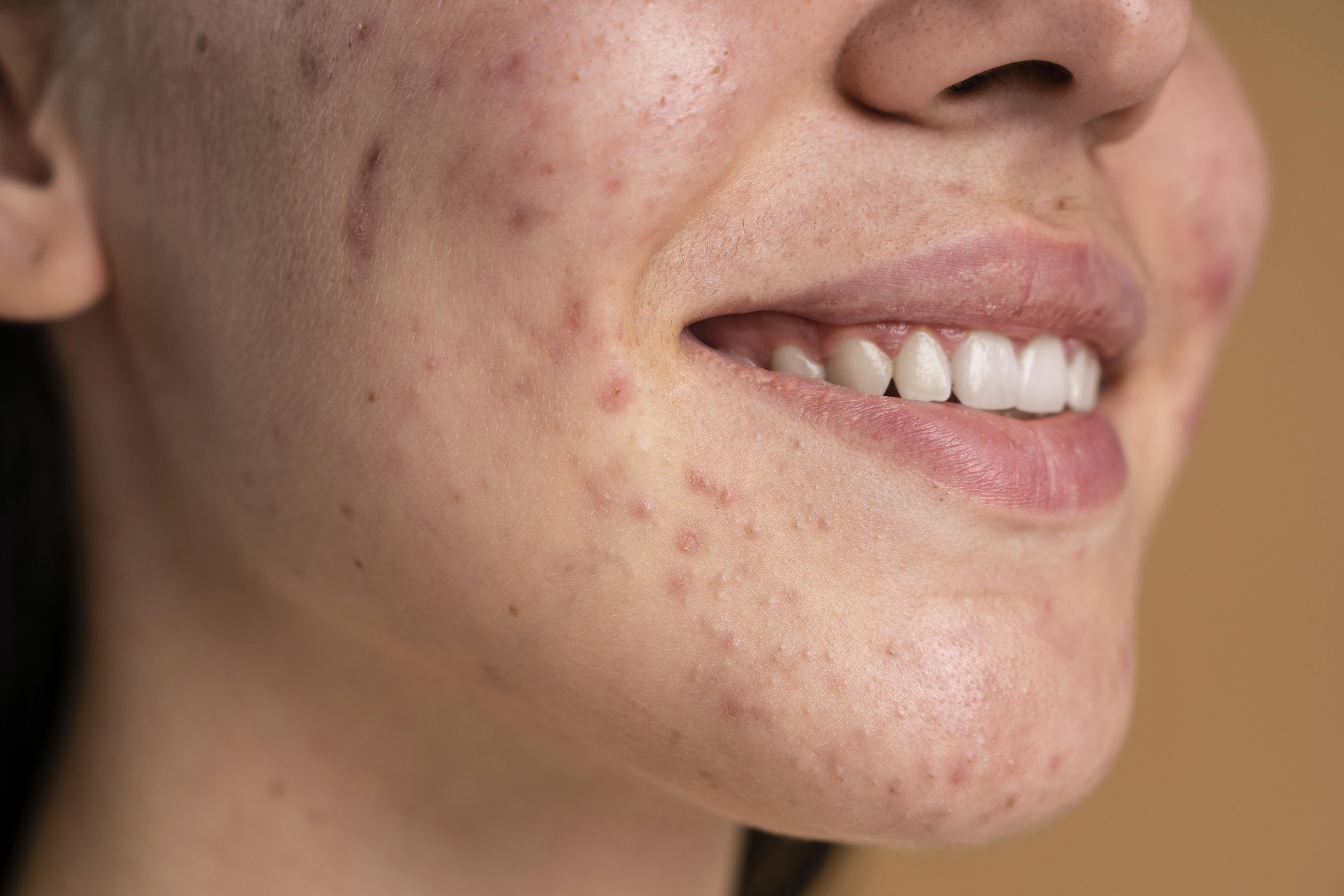 Acne Scarring Context