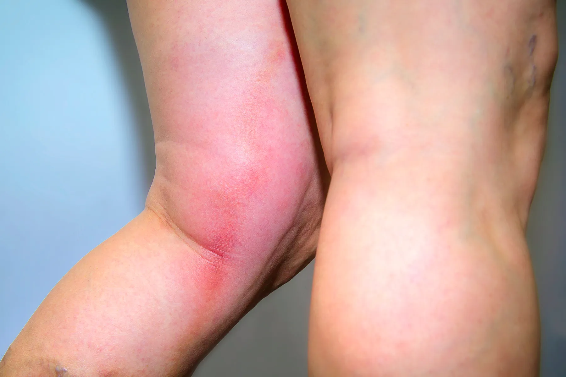 Superficial Vein Assessment